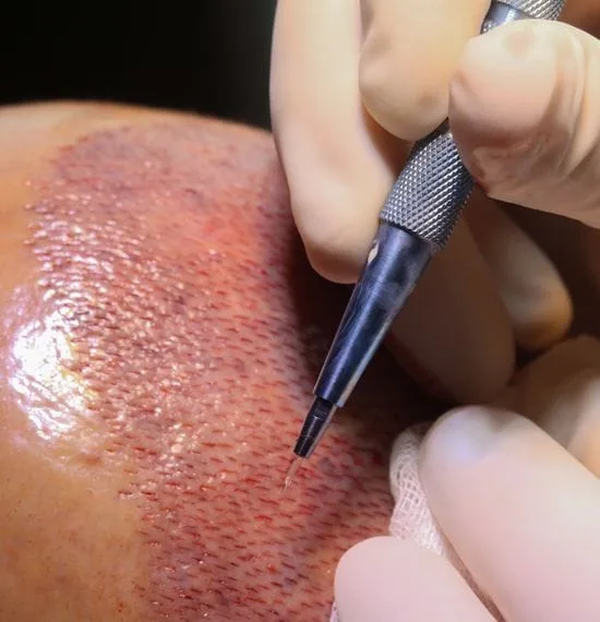 sapphire fue hair transplant