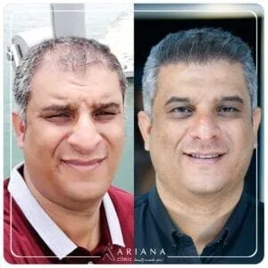 forehead reduction turkey