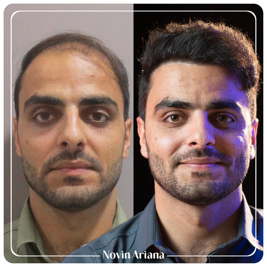 Before After Hamze Nabaie 1