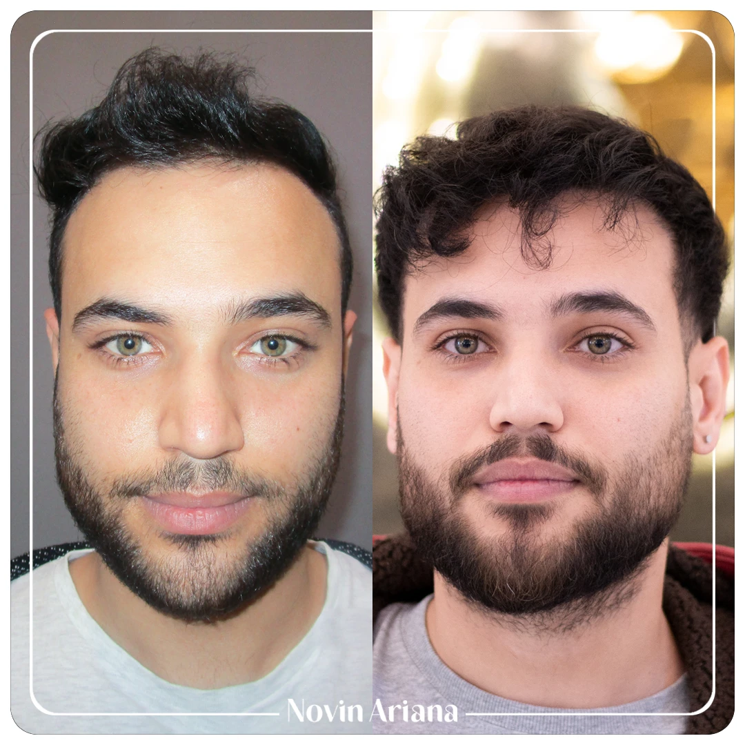 Before After Mohammad Mokarami 1