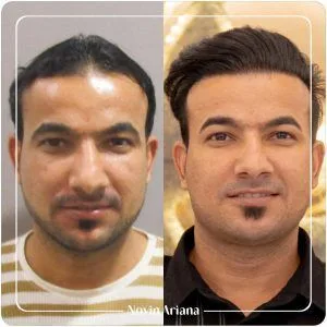هزینه کاشت مو در ترکیه