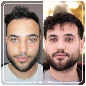 هزینه کاشت مو در ترکیه