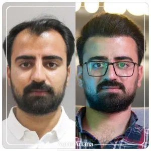 هزینه کاشت مو در ترکیه