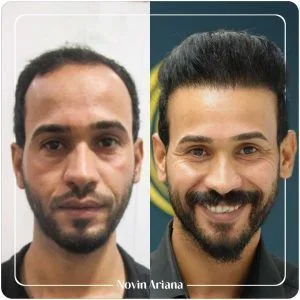 هزینه کاشت مو در ترکیه