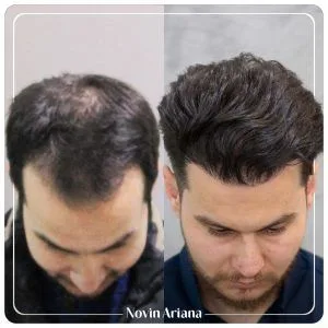 هزینه کاشت مو در ترکیه