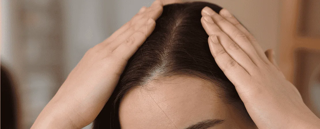 Pimples After Hair Transplant: Causes, Prevention, and Treatment