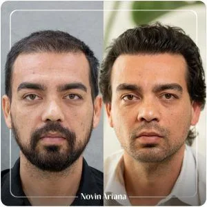 کاشت مو به روش fit بهتر است یا fut