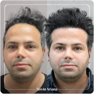 روش کاشت مو مایکروپوینت چیه