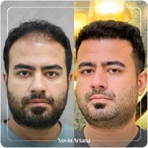 مراحل کاشت مو
