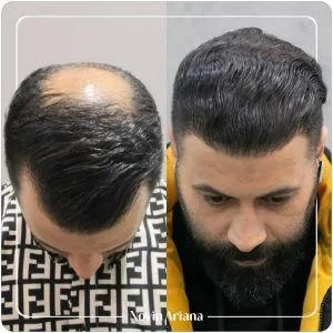 جدیدترین روش کاشت مو