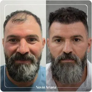 کاشت مو در ترکیه جدیدترین روش کاشت مو در ترکیه قیمت کاشت مو در ترکیه کاشت مو قبل و بعد کاشت مو زنان در ترکیه کاشت مو مردان در ترکیه نوین آریانا بهترین کلینیک کاشت مو در ترکیه بعد از کاشت مو چه اتفاقی می افتد؟ دکتر ایرانی کاشت مو در ترکیه تکنسین کاشت مو در ترکیه کاشت مو بازیگران ترکیه نوین آریانا بهترین مرکز کاشت مو ترکیه بهترین کلینیک های کاشت مو ترکیه قیمت کاشت مو ترکیه کاشت مو با سلولهای بنیادی در ترکیه