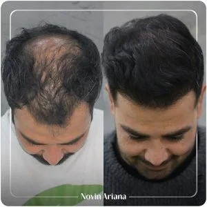 کاشت مو در ترکیه جدیدترین روش کاشت مو در ترکیه قیمت کاشت مو در ترکیه کاشت مو قبل و بعد کاشت مو زنان در ترکیه کاشت مو مردان در ترکیه نوین آریانا بهترین کلینیک کاشت مو در ترکیه بعد از کاشت مو چه اتفاقی می افتد؟ دکتر ایرانی کاشت مو در ترکیه تکنسین کاشت مو در ترکیه کاشت مو بازیگران ترکیه نوین آریانا بهترین مرکز کاشت مو ترکیه بهترین کلینیک های کاشت مو ترکیه قیمت کاشت مو ترکیه کاشت مو با سلولهای بنیادی در ترکیه