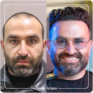 کاشت مو در ترکیه جدیدترین روش کاشت مو در ترکیه قیمت کاشت مو در ترکیه کاشت مو قبل و بعد کاشت مو زنان در ترکیه کاشت مو مردان در ترکیه نوین آریانا بهترین کلینیک کاشت مو در ترکیه بعد از کاشت مو چه اتفاقی می افتد؟ دکتر ایرانی کاشت مو در ترکیه تکنسین کاشت مو در ترکیه کاشت مو بازیگران ترکیه نوین آریانا بهترین مرکز کاشت مو ترکیه بهترین کلینیک های کاشت مو ترکیه قیمت کاشت مو ترکیه کاشت مو با سلولهای بنیادی در ترکیه