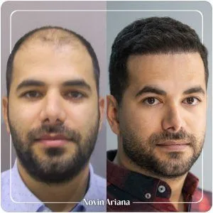 کاشت مو در ترکیه جدیدترین روش کاشت مو در ترکیه قیمت کاشت مو در ترکیه کاشت مو قبل و بعد کاشت مو زنان در ترکیه کاشت مو مردان در ترکیه نوین آریانا بهترین کلینیک کاشت مو در ترکیه بعد از کاشت مو چه اتفاقی می افتد؟ دکتر ایرانی کاشت مو در ترکیه تکنسین کاشت مو در ترکیه کاشت مو بازیگران ترکیه نوین آریانا بهترین مرکز کاشت مو ترکیه بهترین کلینیک های کاشت مو ترکیه قیمت کاشت مو ترکیه کاشت مو با سلولهای بنیادی در ترکیه