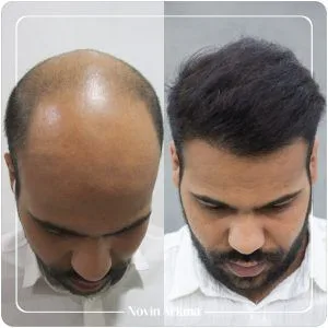 کاشت مو در ترکیه جدیدترین روش کاشت مو در ترکیه قیمت کاشت مو در ترکیه کاشت مو قبل و بعد کاشت مو زنان در ترکیه کاشت مو مردان در ترکیه نوین آریانا بهترین کلینیک کاشت مو در ترکیه بعد از کاشت مو چه اتفاقی می افتد؟ دکتر ایرانی کاشت مو در ترکیه تکنسین کاشت مو در ترکیه کاشت مو بازیگران ترکیه نوین آریانا بهترین مرکز کاشت مو ترکیه بهترین کلینیک های کاشت مو ترکیه قیمت کاشت مو ترکیه کاشت مو با سلولهای بنیادی در ترکیه