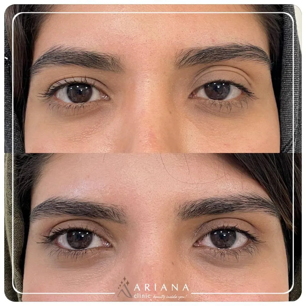 Before After Blepharo 11 min 1024x1024 1