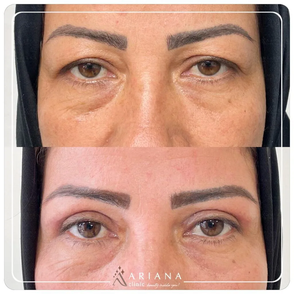 Before After Blepharo 14 min 1024x1024 1