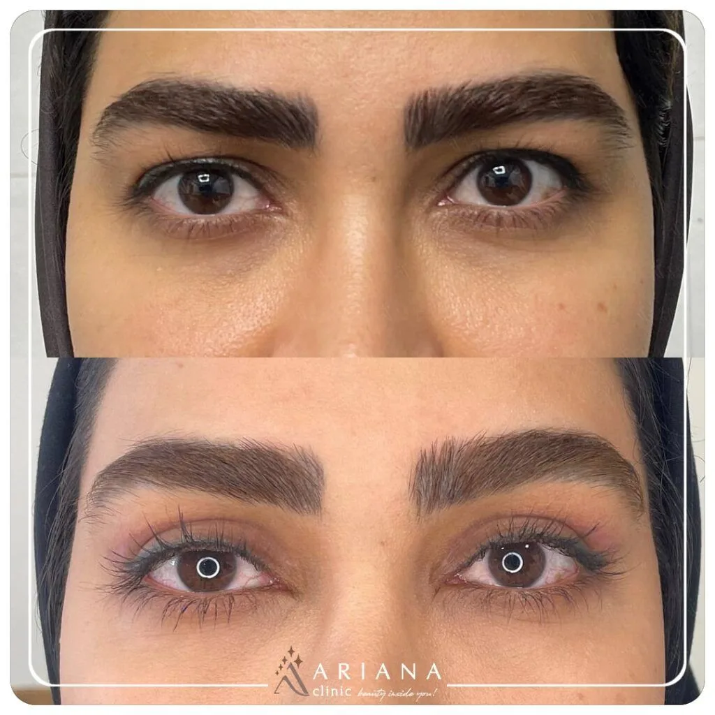 Before After Blepharo 15 min 1 1024x1024 1