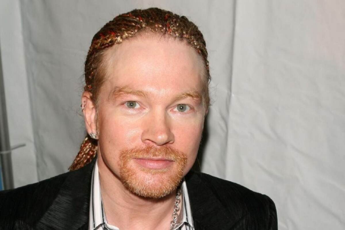 axl rose hair transplant (3)