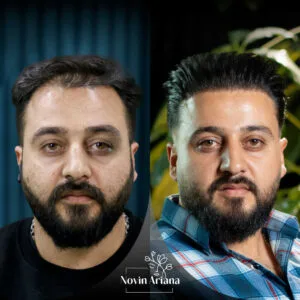 trasplante de pelo en turquía 4