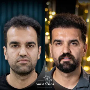 trasplante de pelo en turquía 4