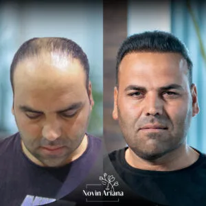 trasplante de cabello en turquia