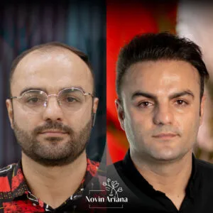 trasplante de cabello en turquia