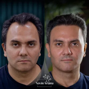 trasplante de cabello en turquia