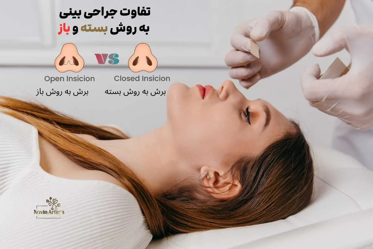 جراحی بینی به روش باز