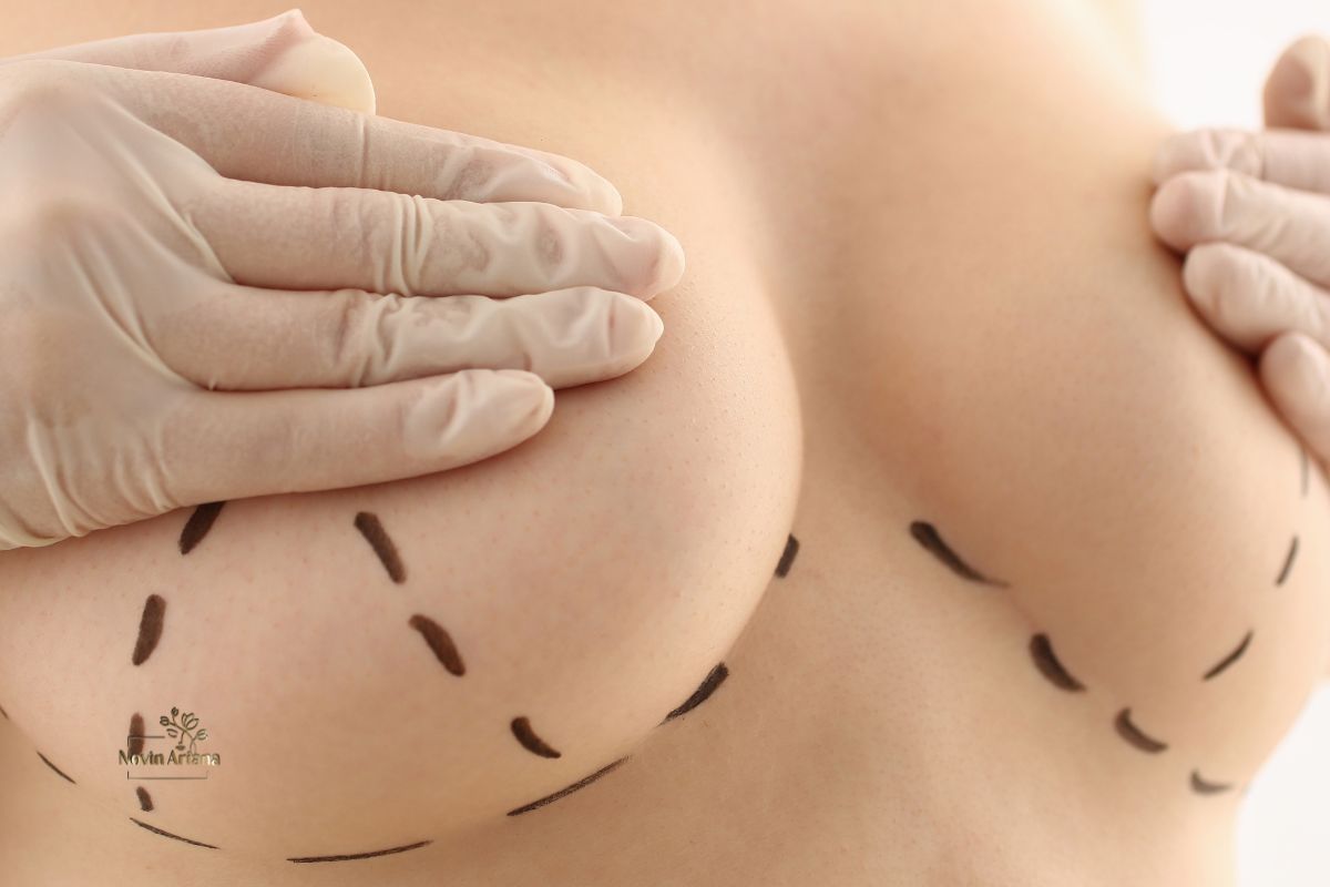 Brustvergrößerung mit Implantaten