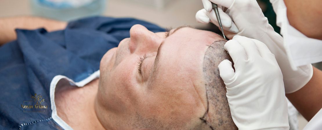 Trapianto di Capelli:Tutto Quello che Devi Sapere