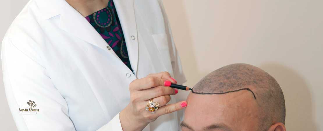 È Doloroso il Trapianto di Capelli?