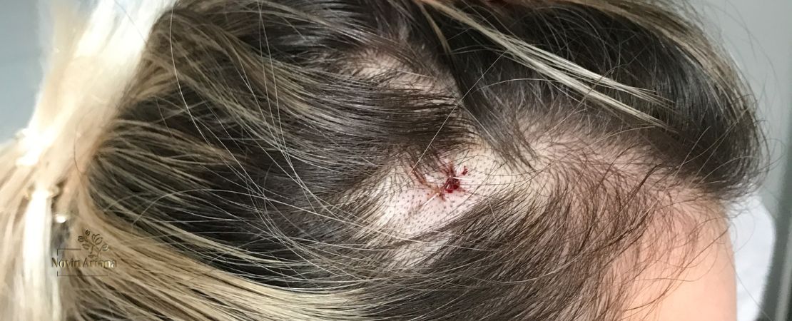 Réparer les Cicatrices Capillaires : Comment Stimuler la Croissance des Cheveux sur les Cicatrices