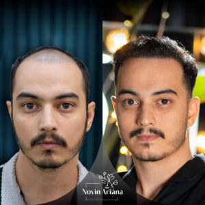 best age for a hair transplant