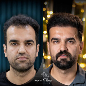 Best age for a hair transplant 3