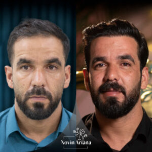 Best age for a hair transplant 4