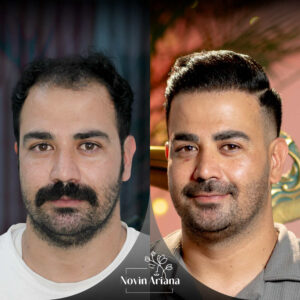 Best age for a hair transplant 8