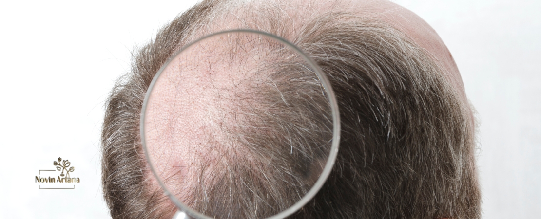 Restauration de la Perte de Cheveux : Guide Complet de la Greffe Capillaire pour la Couronne