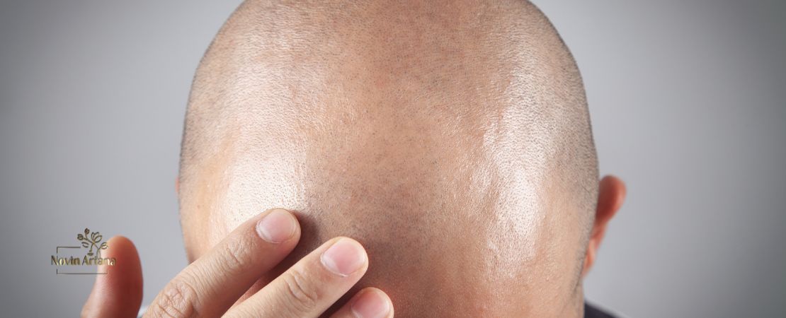 Haartransplantation Vorher Nachher