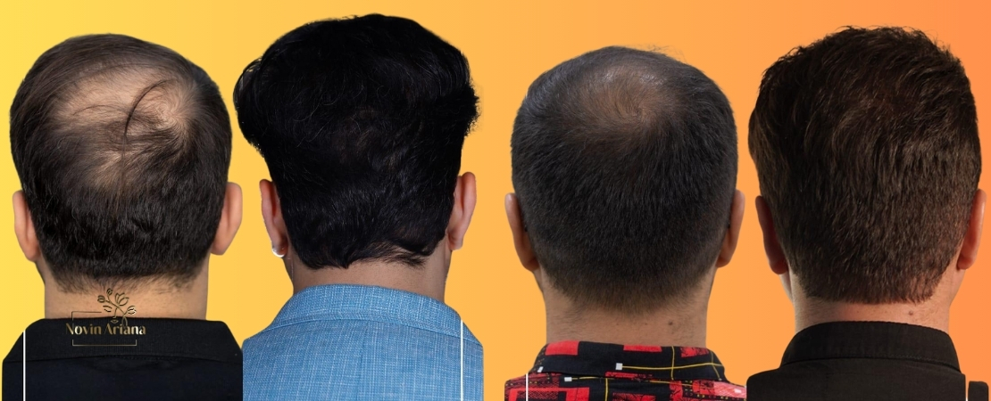 Crown Hair Transplant: A Permanent Solution for Thinning Scalp