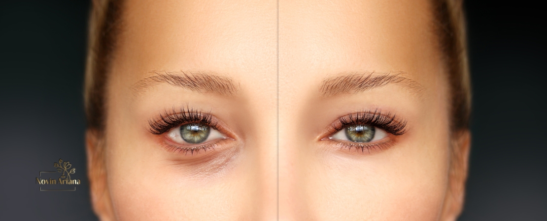 Chirurgie des paupières (blépharoplastie)