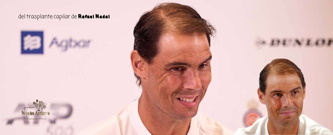 Rafael Nadal y el Trasplante Capilar