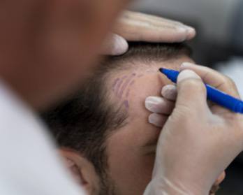 The best Hair Transplant Clinic in Turkey