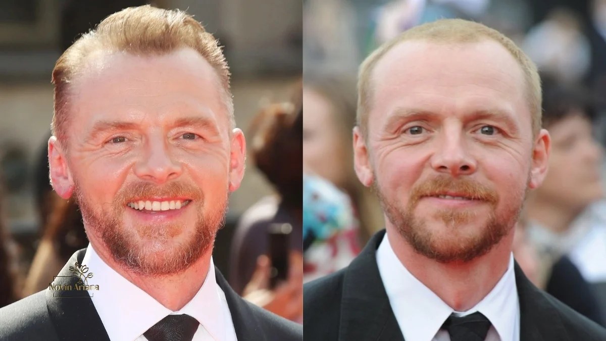 Simon Pegg Hair Transplant, simon pegg hair colour, did simon pegg get a hair transplant