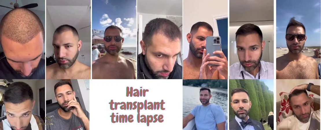 تایملپس کاشت مو: مشاهده نتایج واقعی بهصورت ماهبهماه