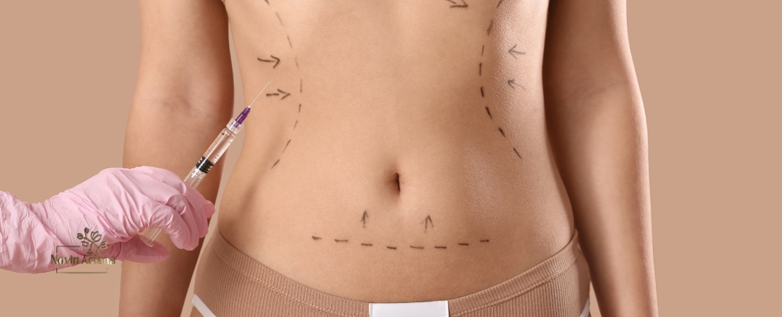 Liposuction Recovery: What to Expect and How to Maintain Your Results