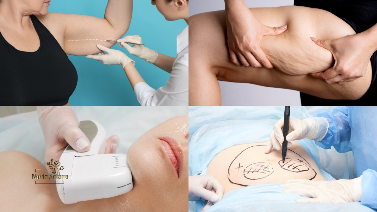 does liposuction leave scars? ,Liposuction scars removal, Liposuction scar treatment, Liposuction scar cream, Liposuction scar healing, Liposuction scar reduction, Liposuction scar photos, Liposuction scar recovery, Liposuction scar prevention, Liposuction scar laser, Liposuction scar revision