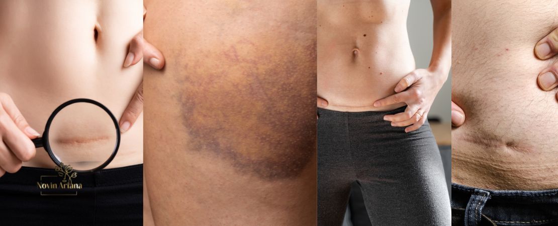 Fettabsaugung Bauch: Risiken, Narben und 7 ungeschminkte Wahrheit über schöne Körperkonturen