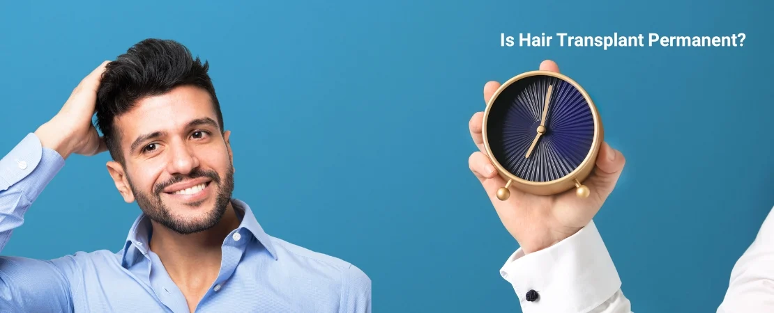 Before and after results of a successful hair restoration procedure – answering the question: do hair transplant last forever?"