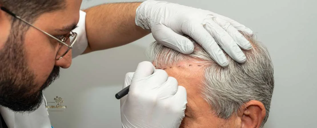 همه چیز درباره خط رویش مو از طراحی تا نتایج نهایی